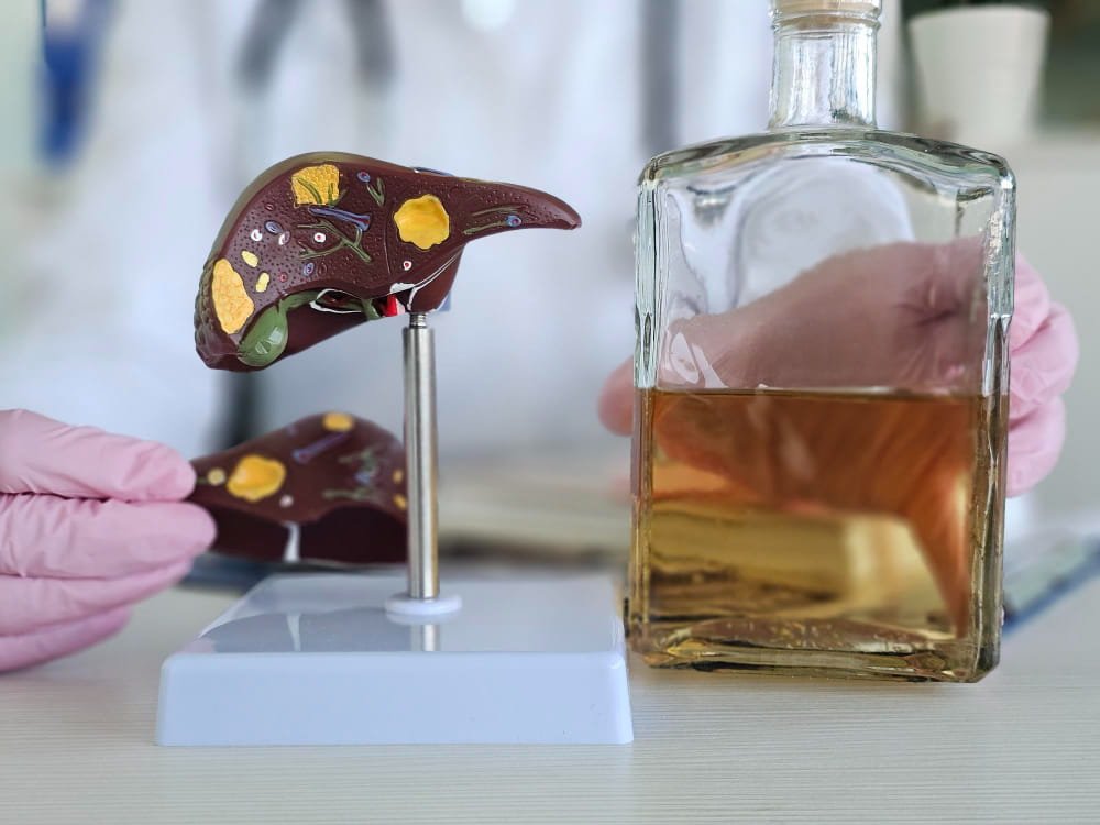 Fatty Liver in Non-Alcoholic